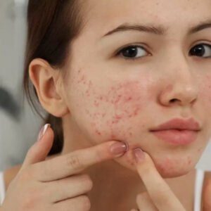 AFL-acne-scars-New